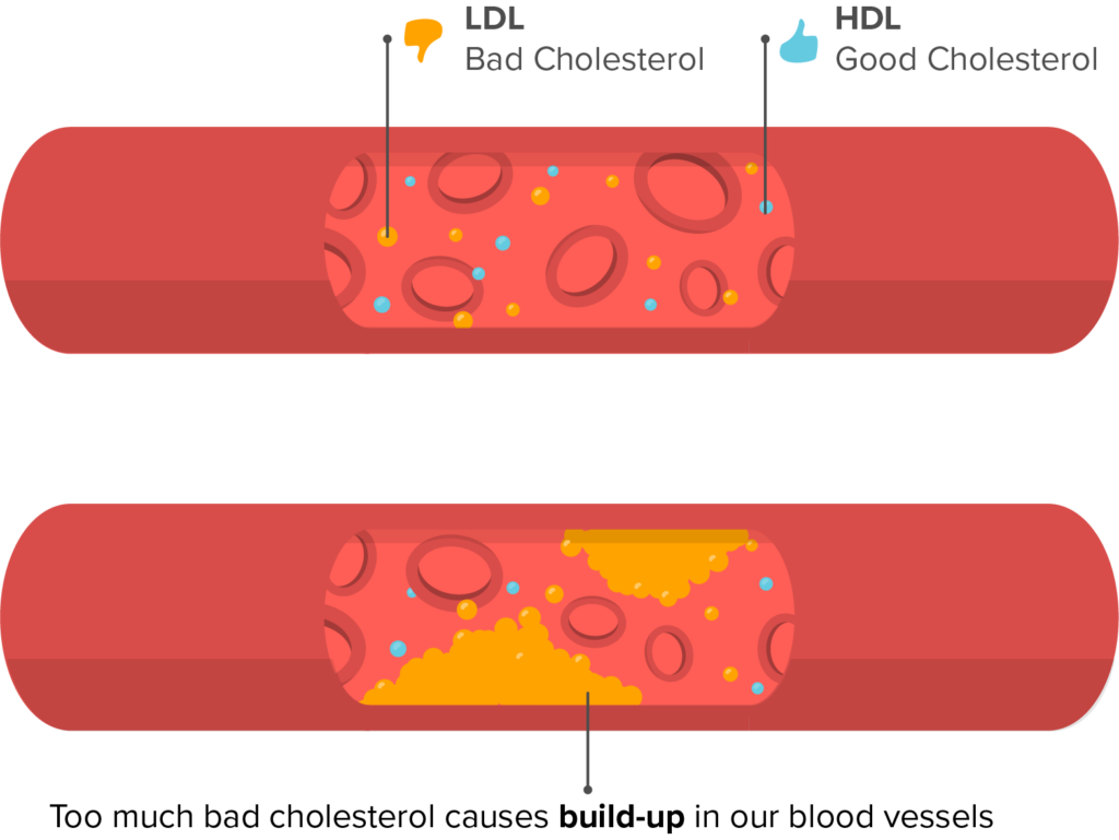 Illustration of high cholesterol
